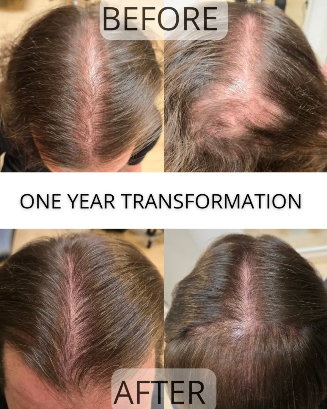 Minoxidil 5% Hair Growth Drops for Women (Made in USA)