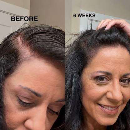 Minoxidil 5% Hair Growth Spray for Women